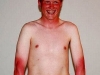 Sunburnt arms Sunburnt arms