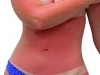 Burnt skin from the sun Burnt skin from the sun