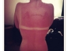 Ouch sunburn Ouch sunburn
